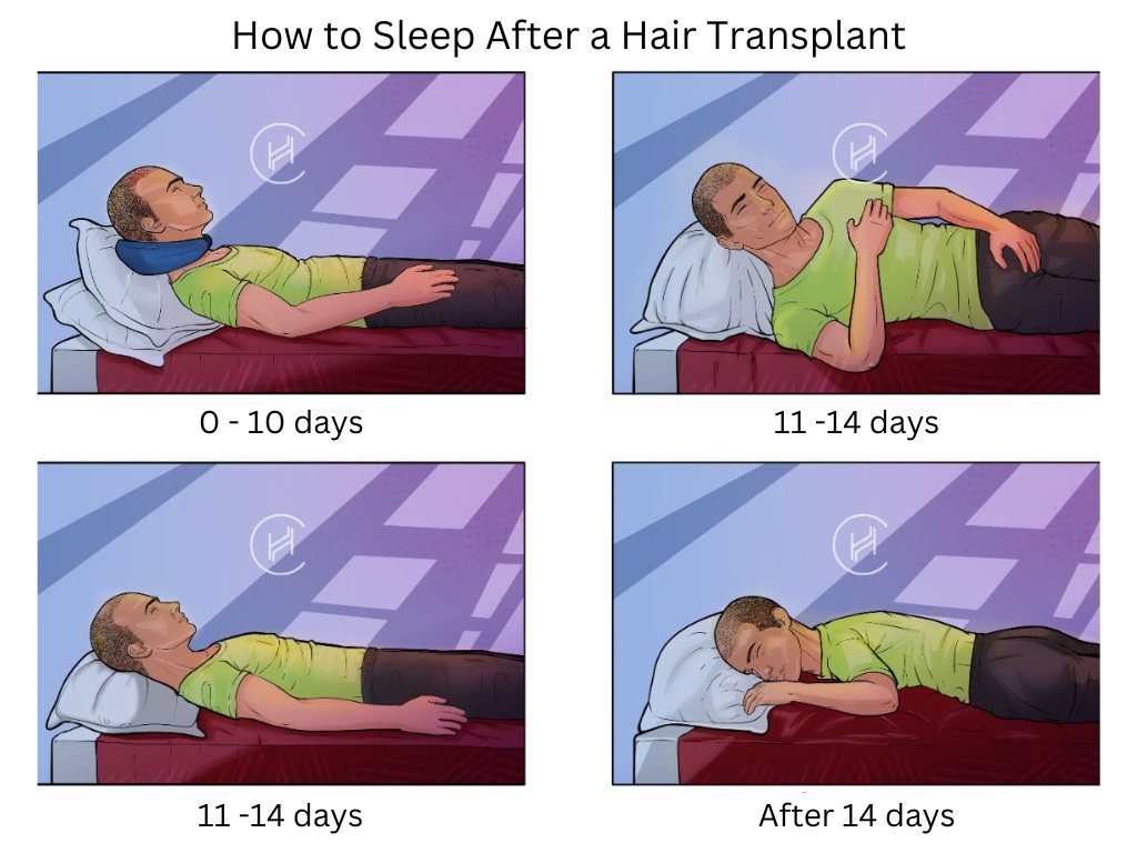 How To Sleep After Hair Transplant